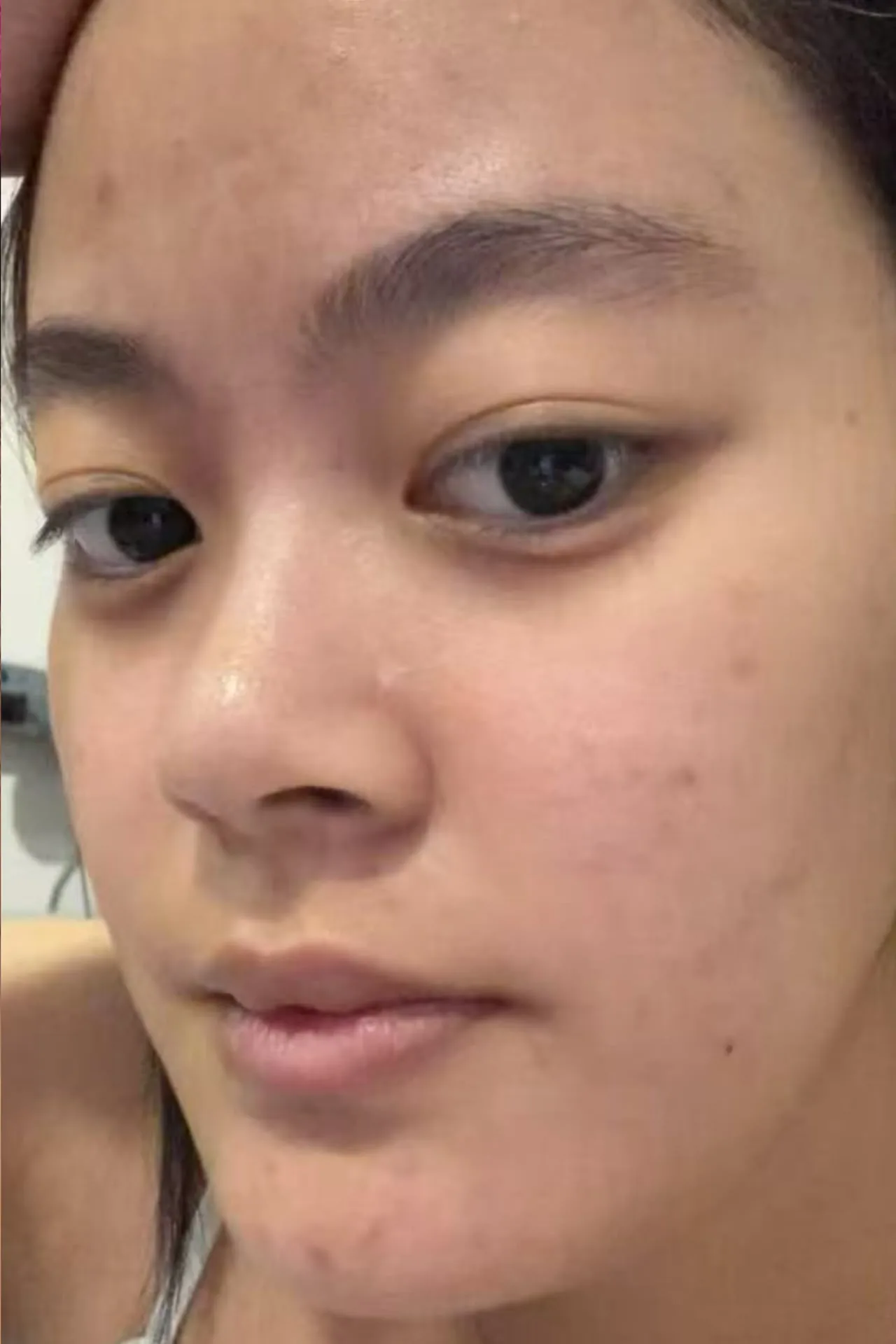 The same client's cheek after treatment, showing clearer and more even skin.