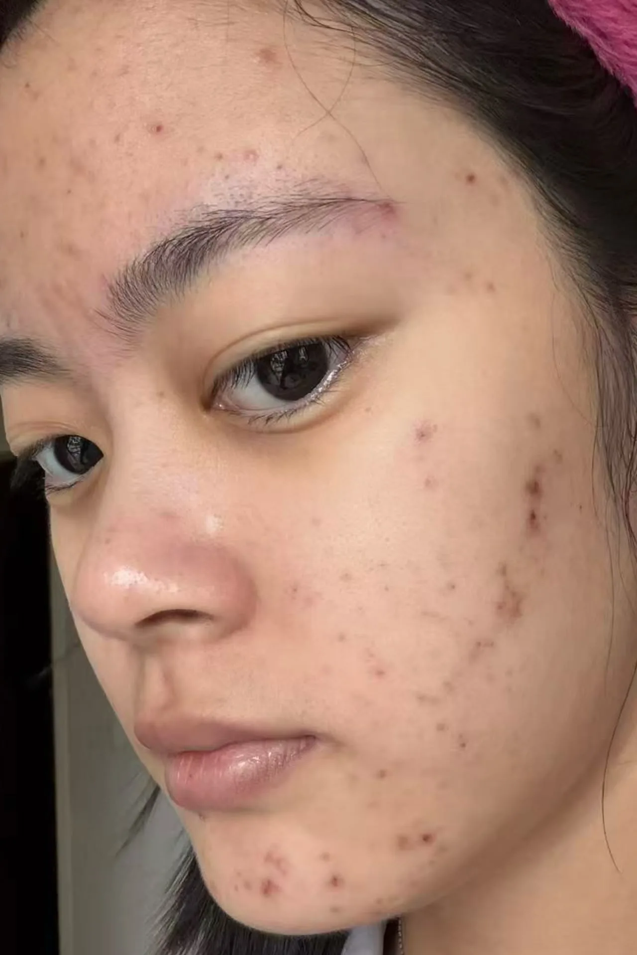 Close-up of a client's cheek before treatment, showing active breakouts and post-acne marks.