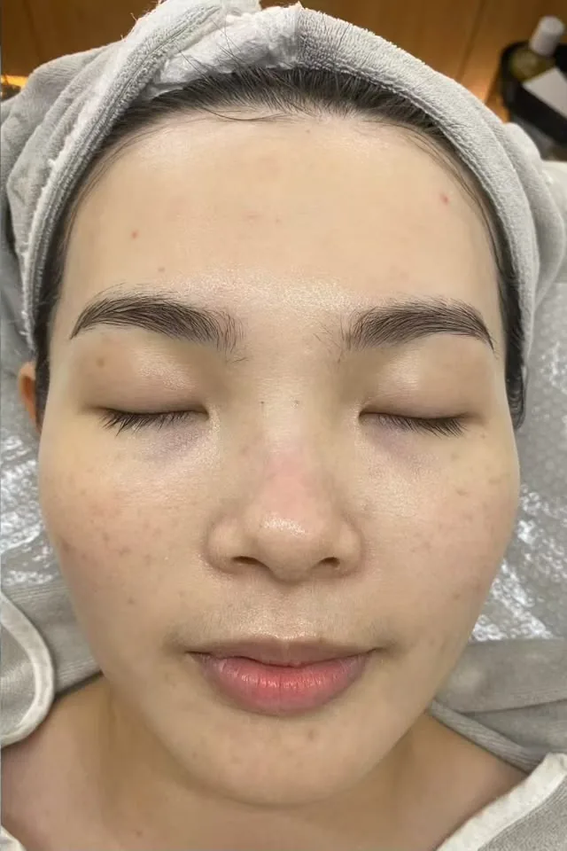 The same client's face after treatment, showing brighter and smoother skin.