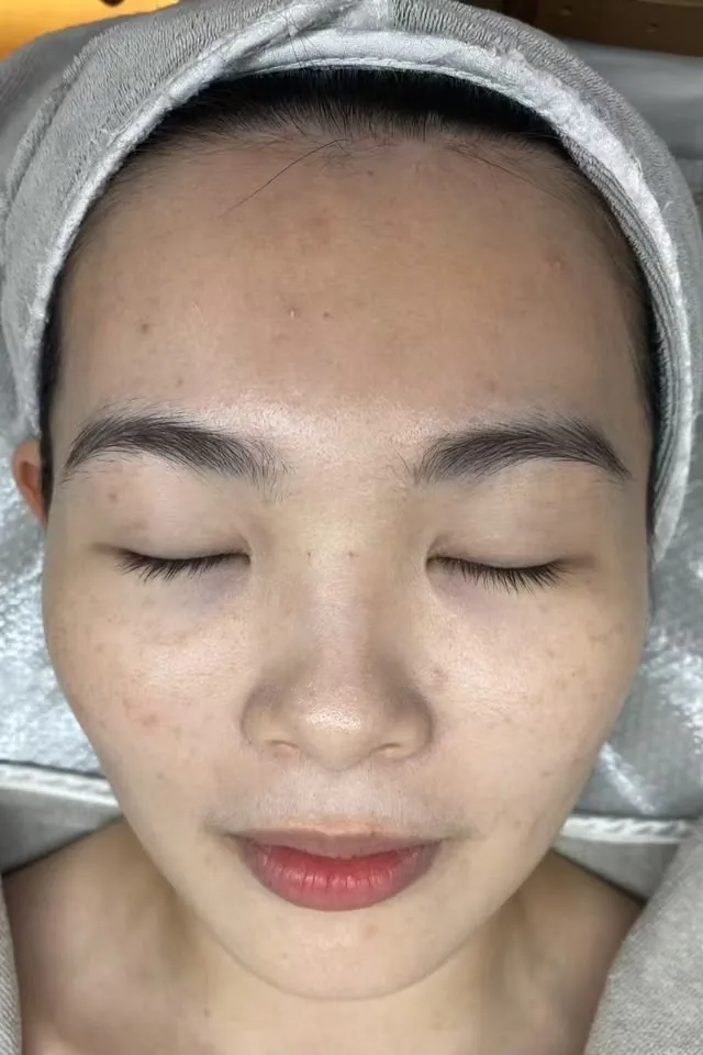 Client's face before treatment, showing dullness and uneven texture across the cheeks.