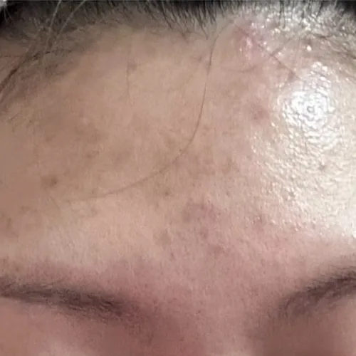The same client's forehead after treatment, showing settled, smoother skin.