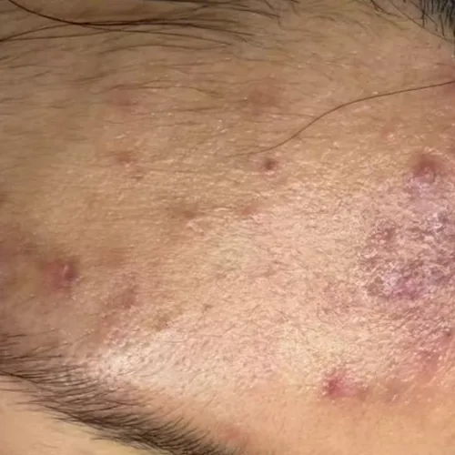 Client's forehead before treatment, showing raised inflamed breakouts.