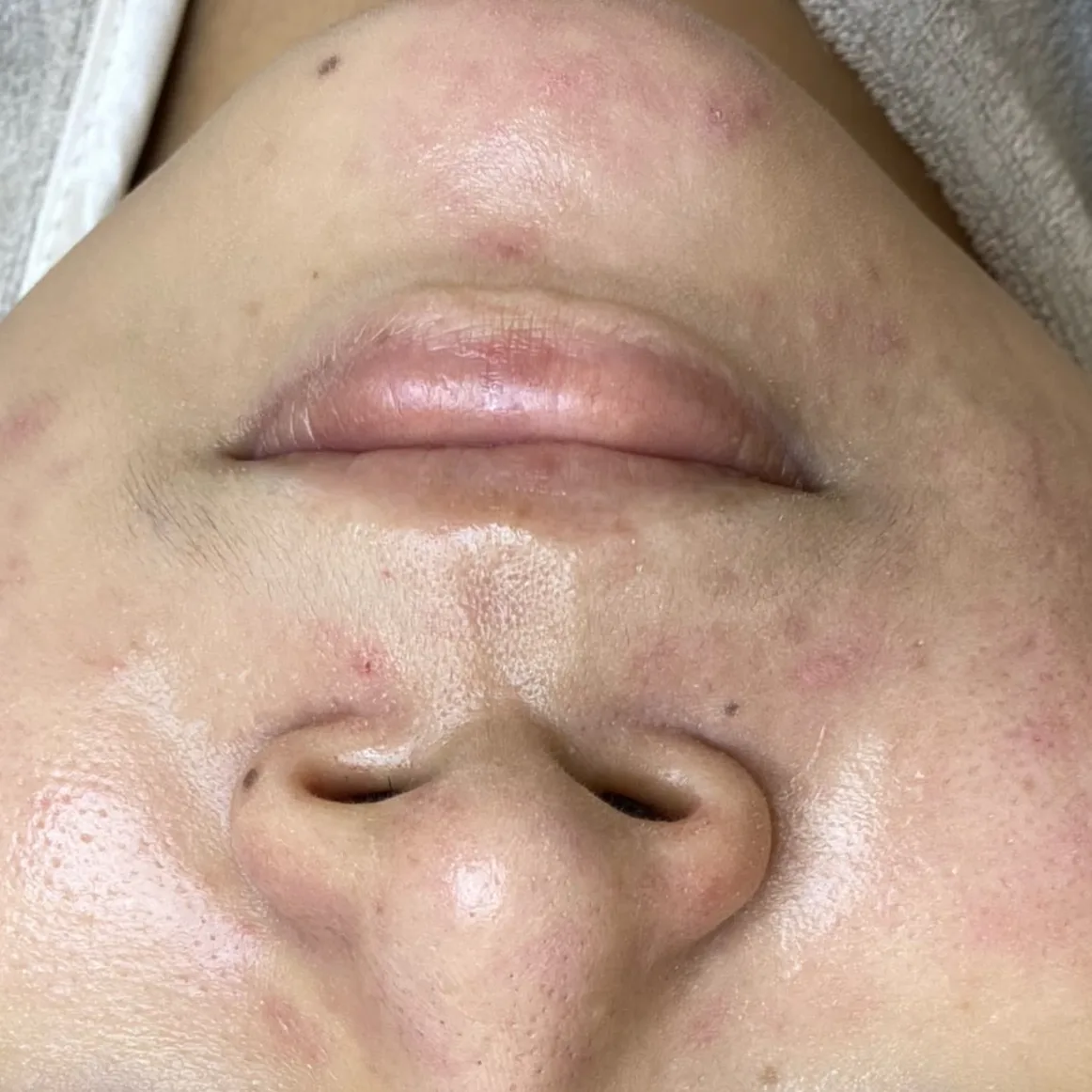 The same client after treatment, with the redness noticeably calmed.