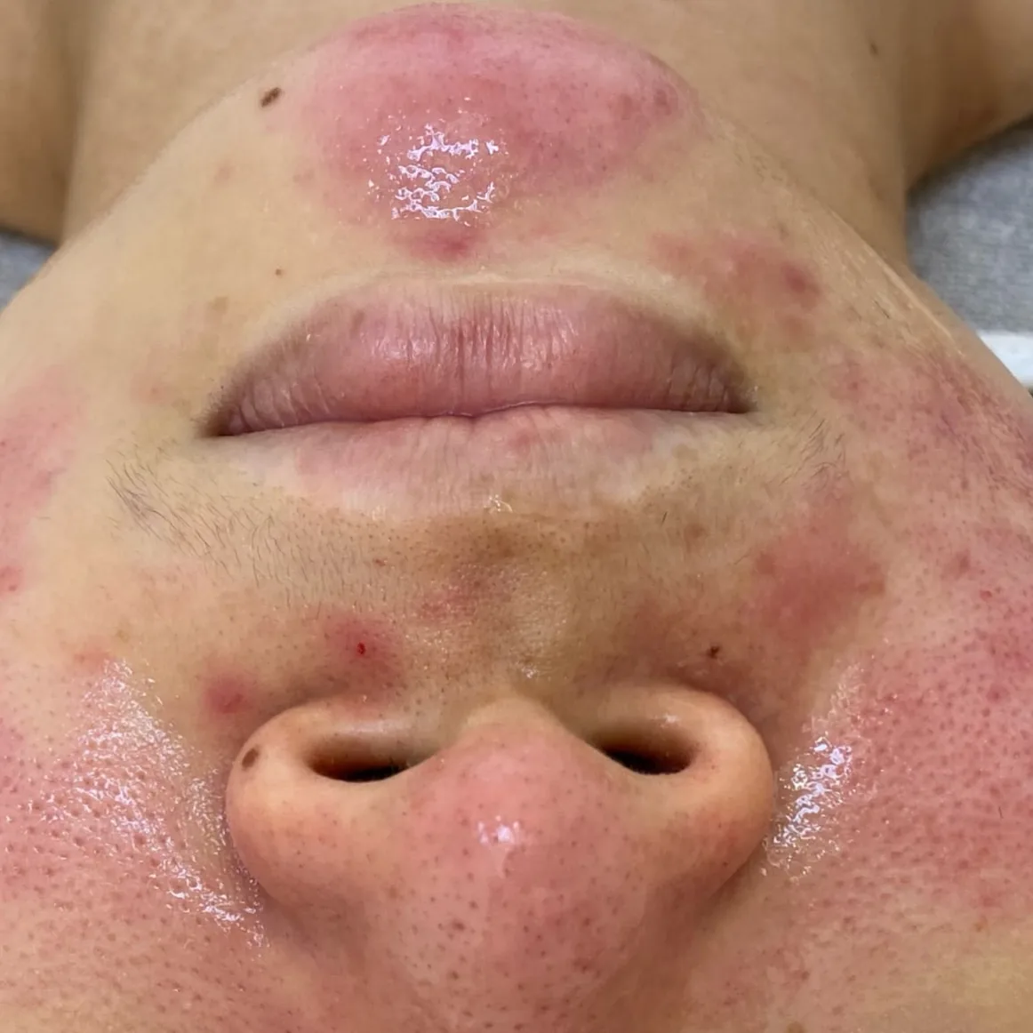Client's cheeks and nose before treatment, showing widespread redness and irritation.