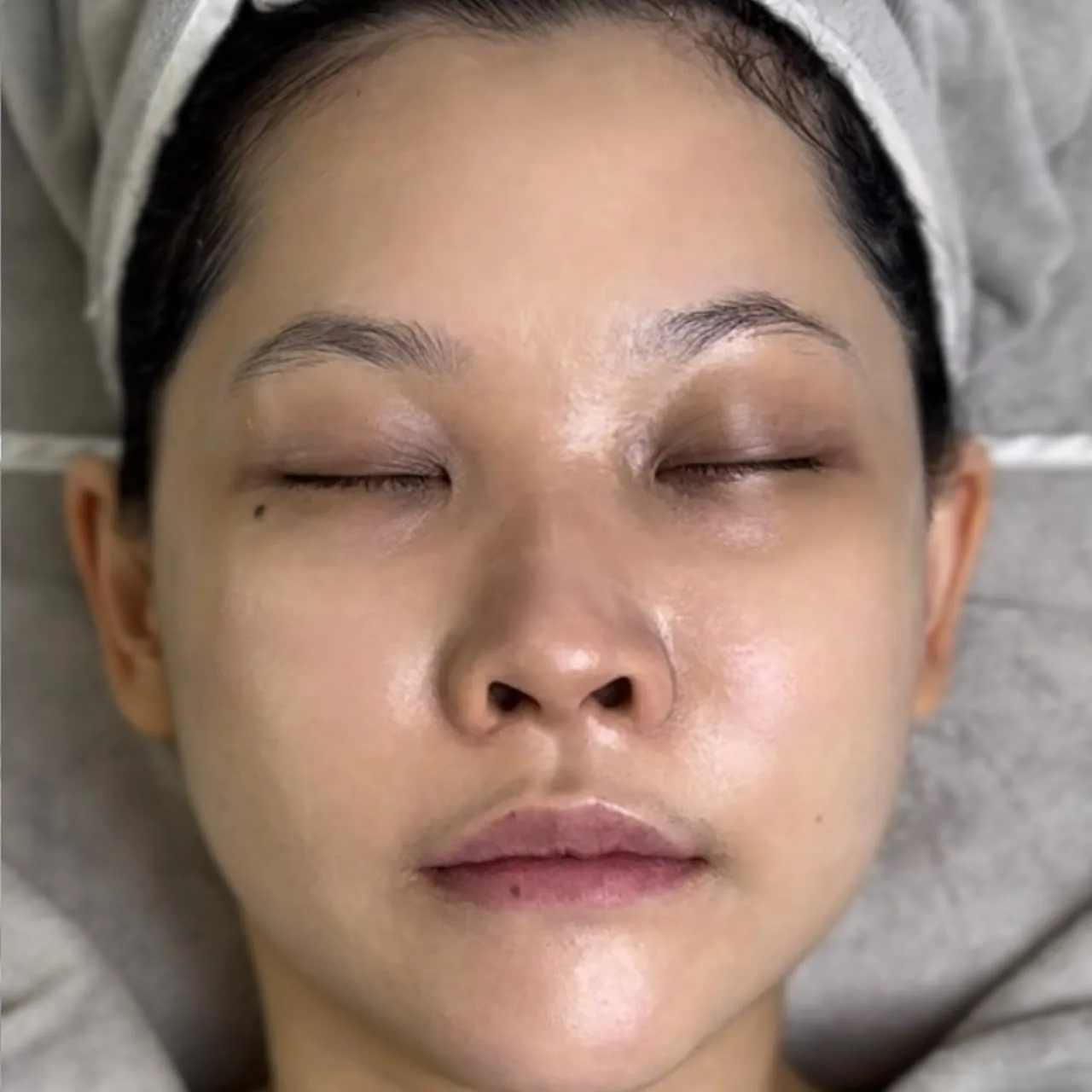 The same client's face after treatment, with clearer, calmer and more even skin.