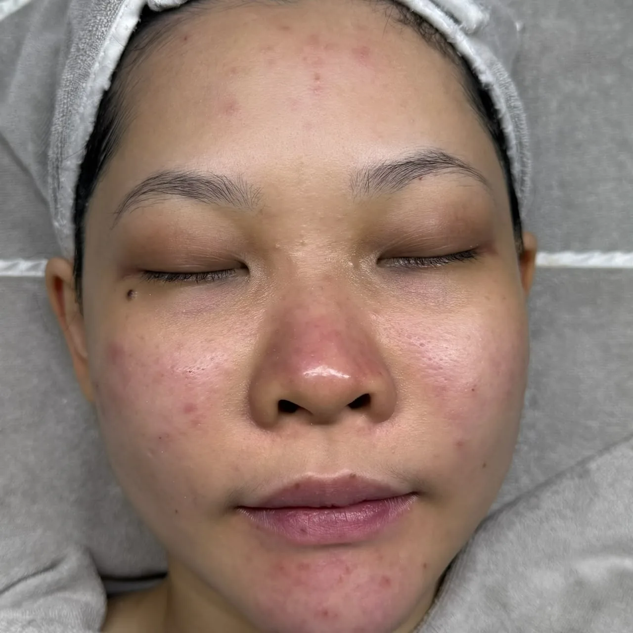 Client's face before treatment, showing breakouts and redness across the cheeks and forehead.