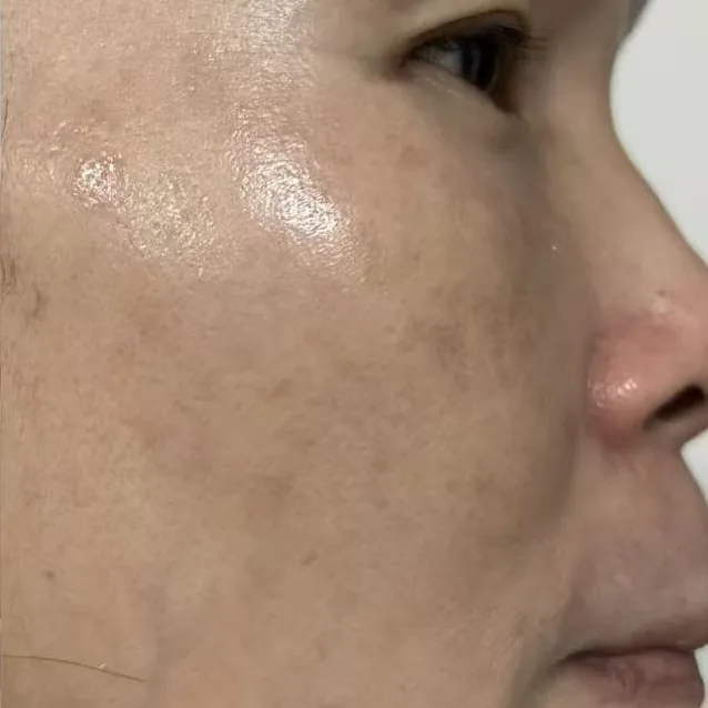 The same client's cheek after treatment, with the pigmentation noticeably faded.
