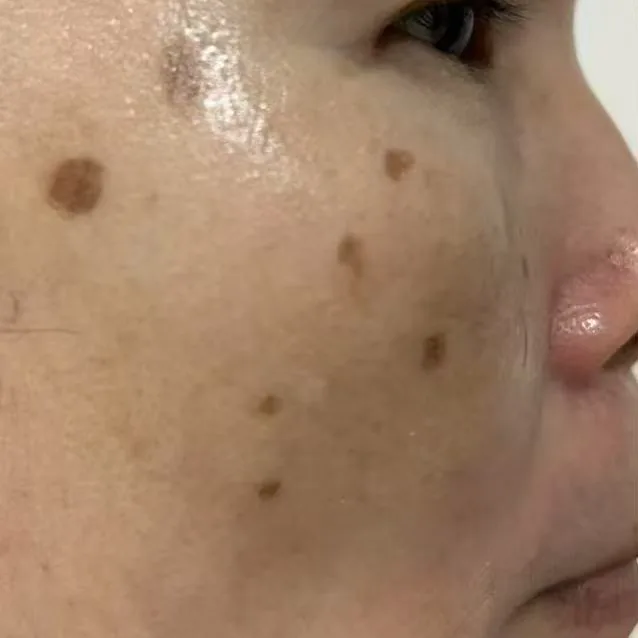 Client's cheek before treatment, showing distinct dark pigmentation spots.